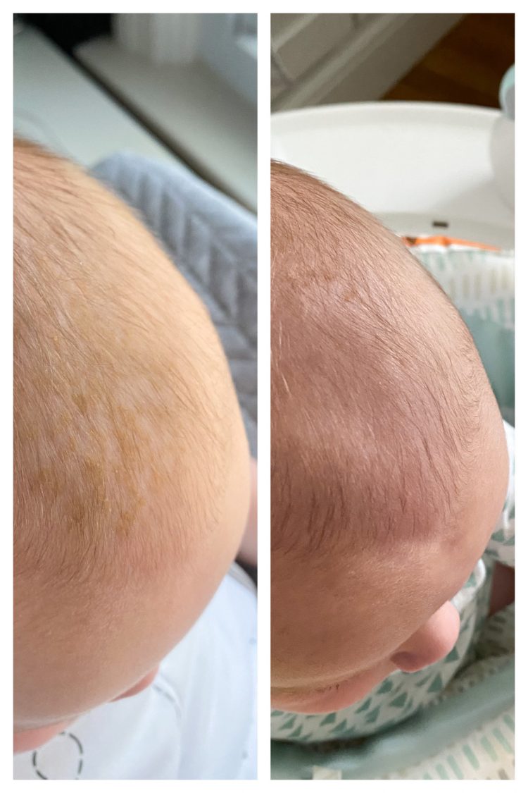 cradle cap before and after