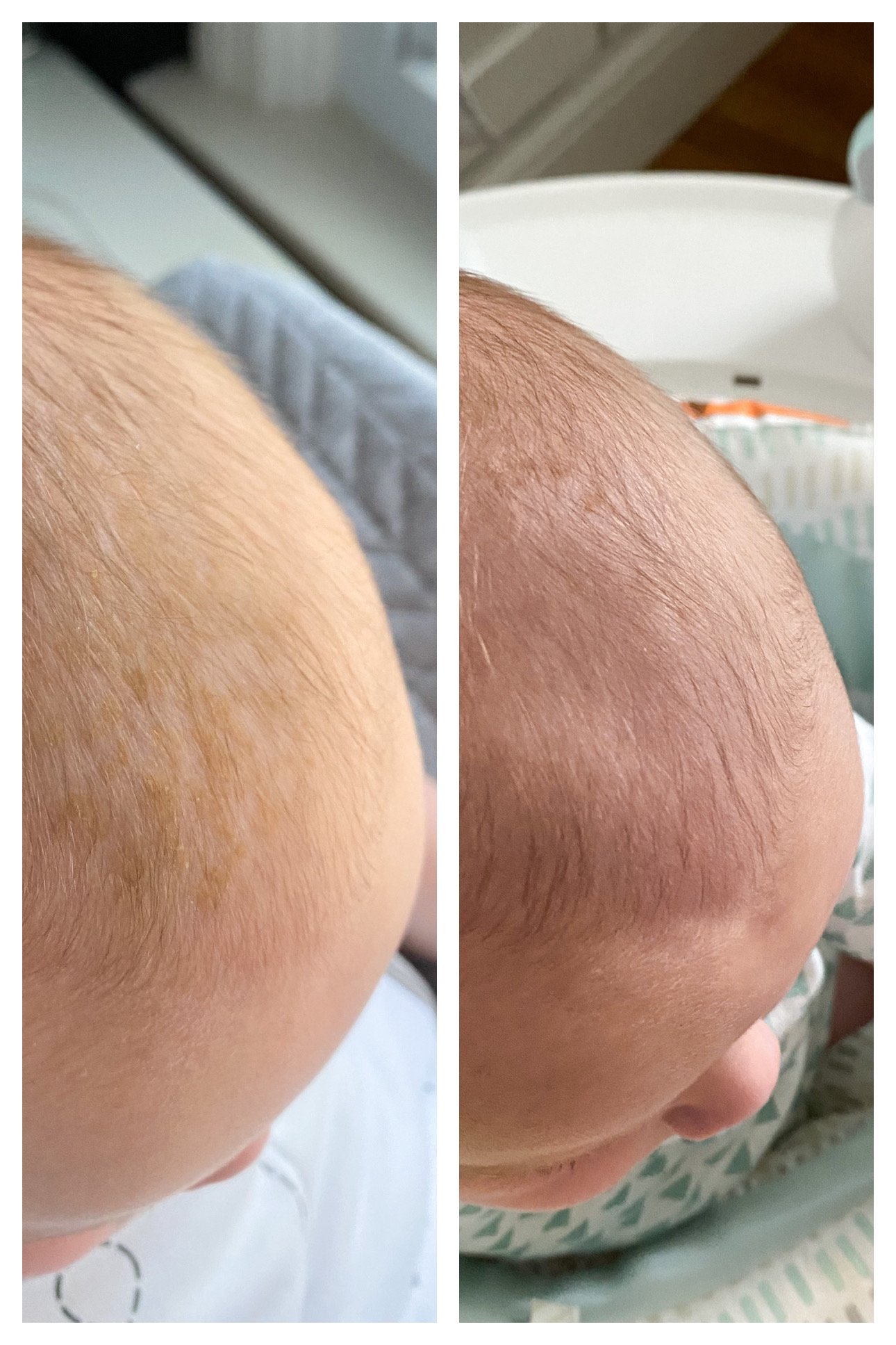 natural cure for cradle cap
